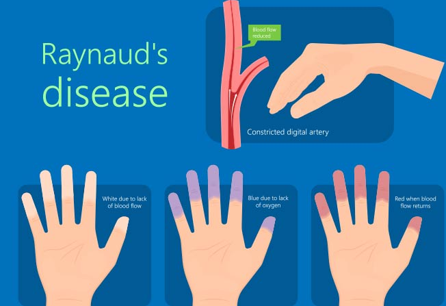 Living with Raynaud's Disease: The Unspoken Challenges